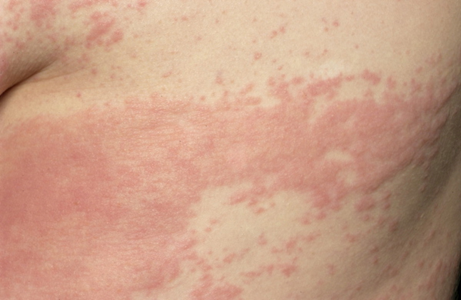 What is Strep Rash in Kids? - Articles For Kids