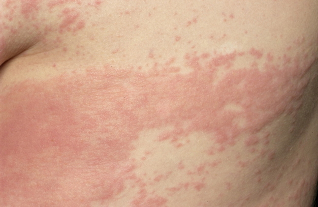 Strep Rash Pictures In Children - Doctor answers on HealthTap