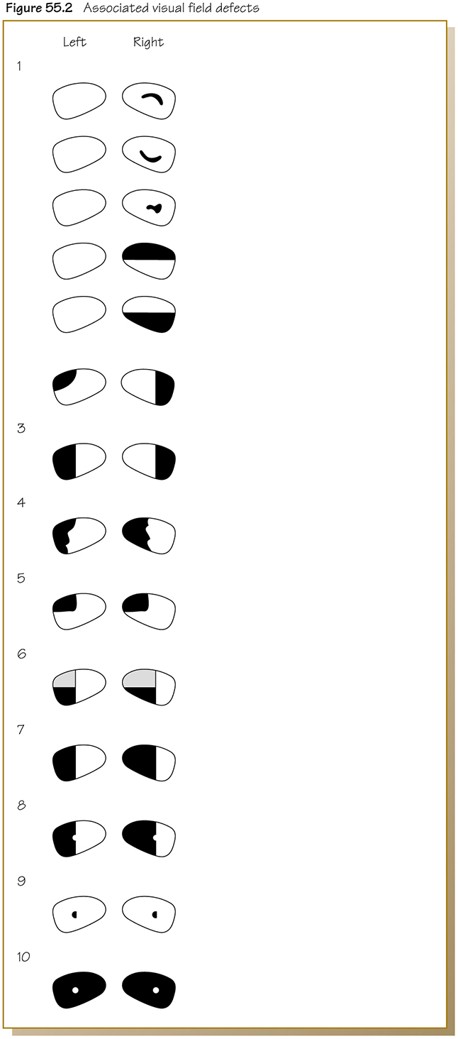 Olver: Ophthalmology at a Glance